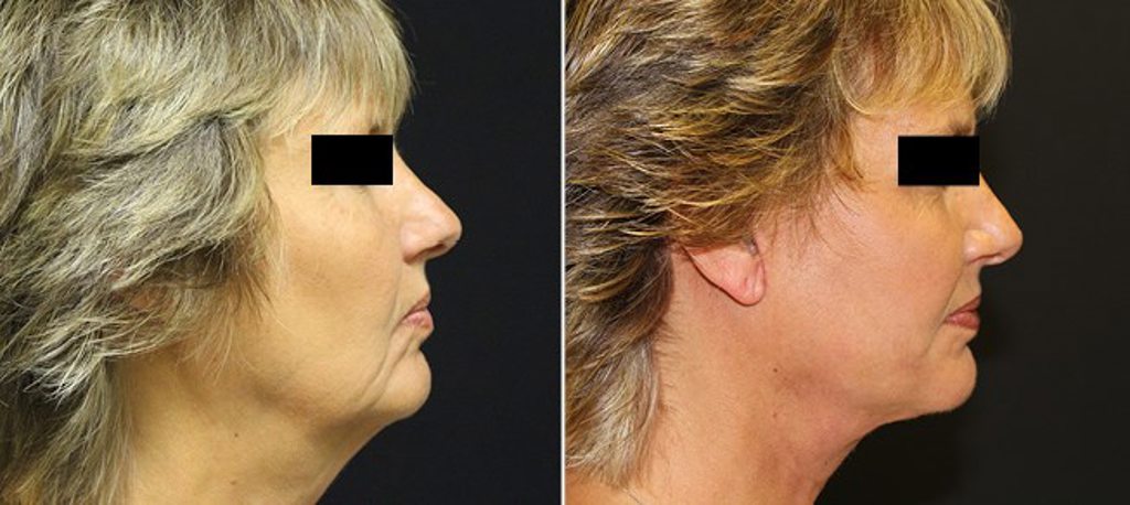 Facelift / Neck Lift