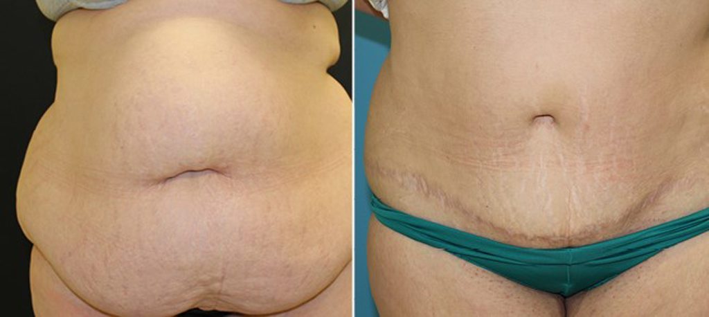 Tummy Tuck (Abdominoplasty)